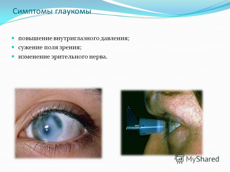Симптомы глаукомы повышение внутриглазного давления; сужение поля зрения; изменение зрительного нерва.
