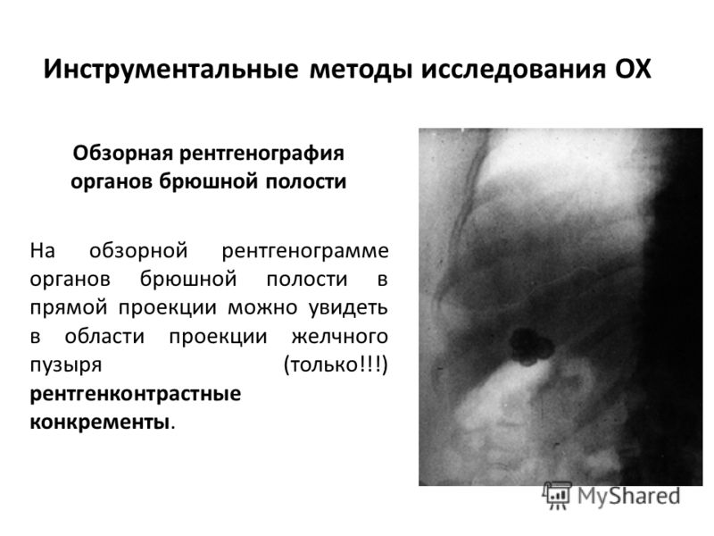 Инструментальные методы исследования ОХ Обзорная рентгенография органов брюшной полости На обзорной рентгенограмме органов брюшной полости в прямой проекции можно увидеть в области проекции желчного пузыря (только!!!) рентгенконтрастные конкременты.