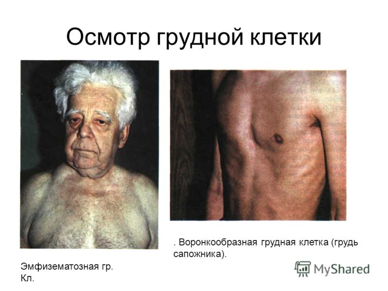 как уменьшить грудную клетку как уменьшить грудную клетку