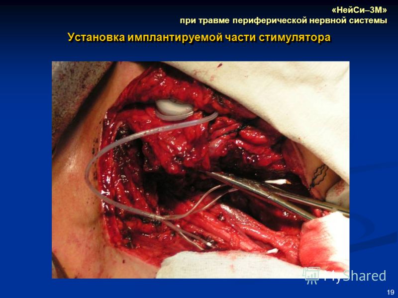 19 Установка имплантируемой части стимулятора «НейСи–3М» при травме периферической нервной системы