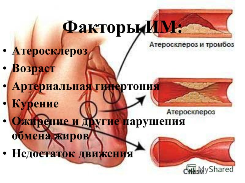 Реферат: Инфаркт миокарда 3