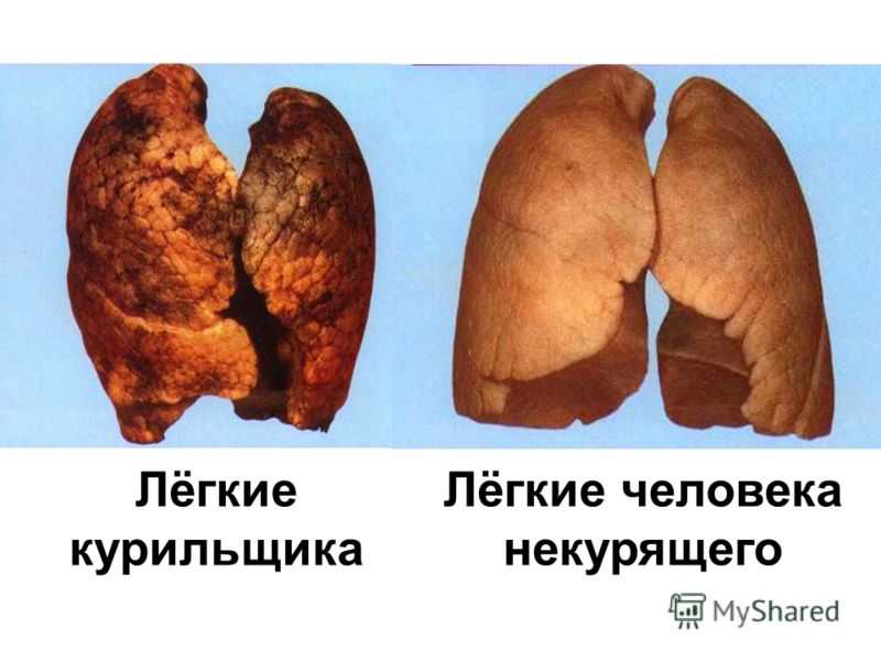 Лёгкие курильщика Лёгкие человека некурящего