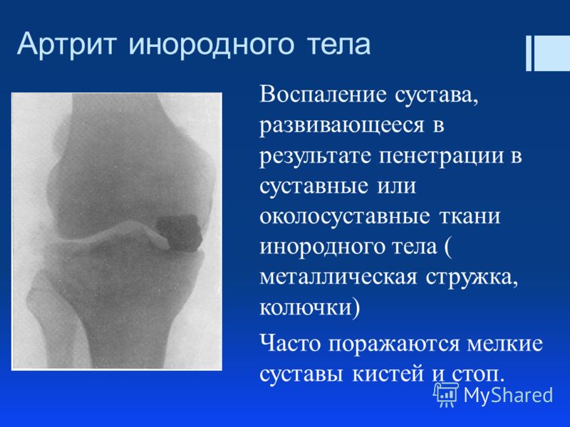 Все суставы на теле воспалились Все суставы на теле воспалились