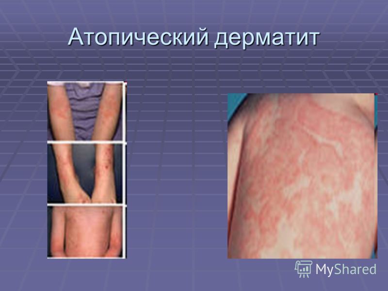 Обострение экземы фото