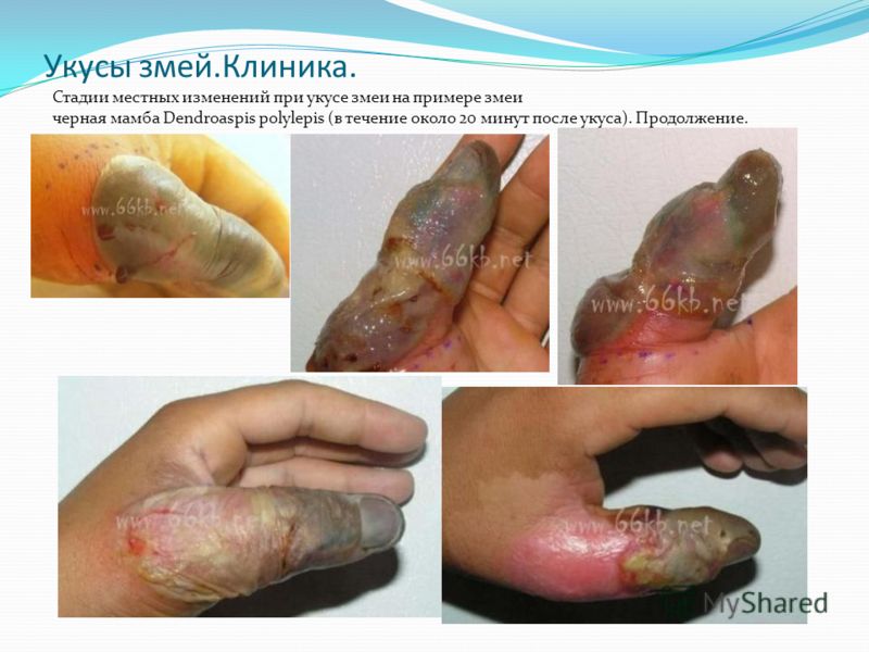 Человек после укуса черной мамбы человек после укуса черной мамбы
