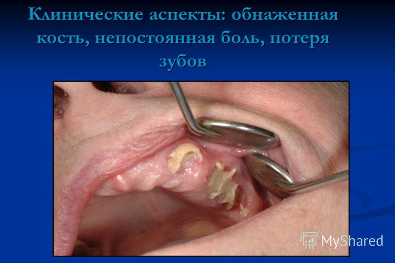 Клинические аспекты: обнаженная кость, непостоянная боль, потеря зубов
