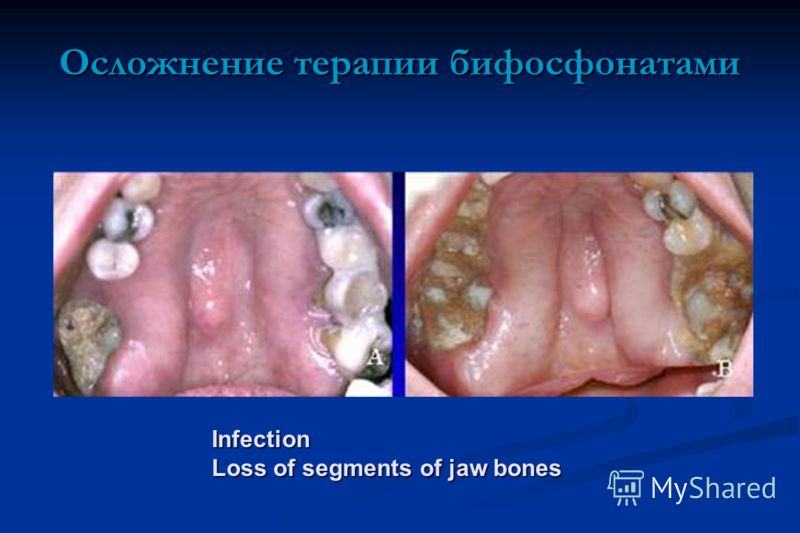 Infection Loss of segments of jaw bones Осложнение терапии бифосфонатами