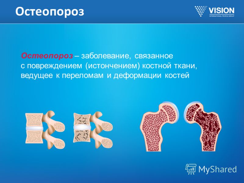 Остеопороз Остеопороз – заболевание, связанное с повреждением (истончением) костной ткани, ведущее к переломам и деформации костей