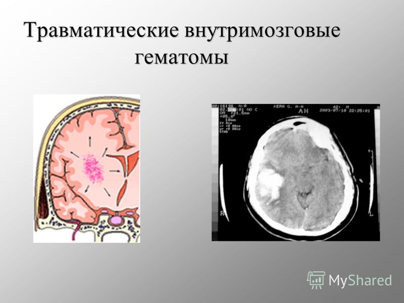 Травматические внутримозговые гематомы
