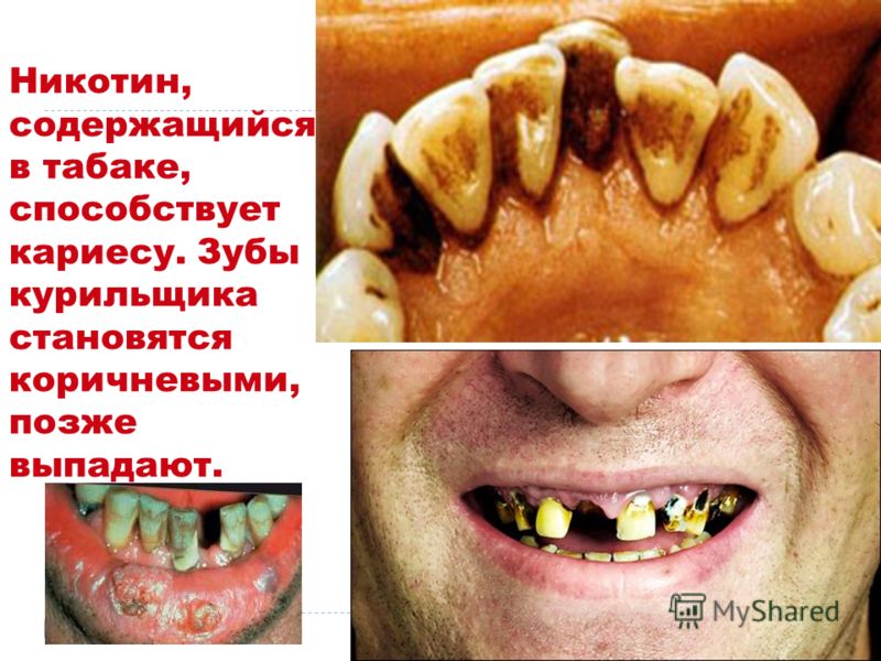 Чем очистить зубы от никотина в домашних условиях Чем очистить зубы от никотина в домашних условиях