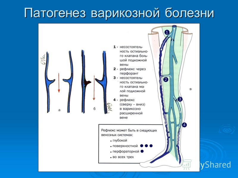 Операция хирургическим путем варикоза