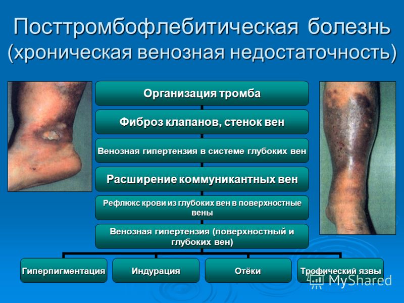 Быстро устают и болят ноги ниже колен