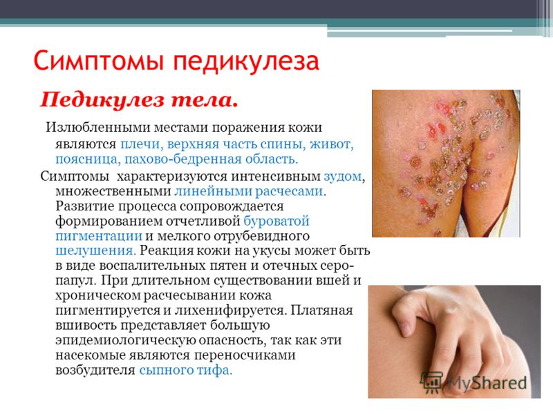 Профилактика педикулеза в домашних условиях