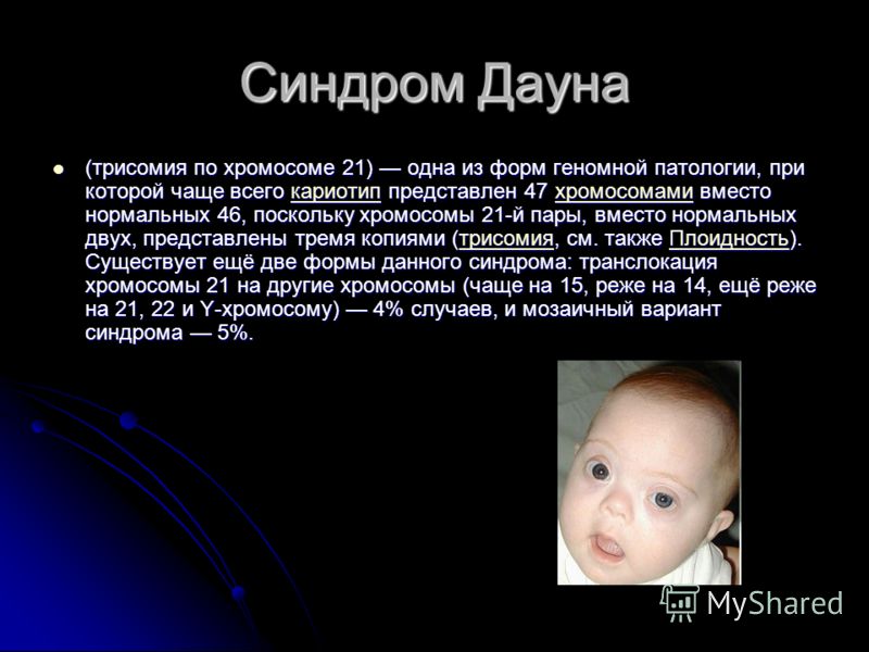 Как выявить синдром дауна в беременность