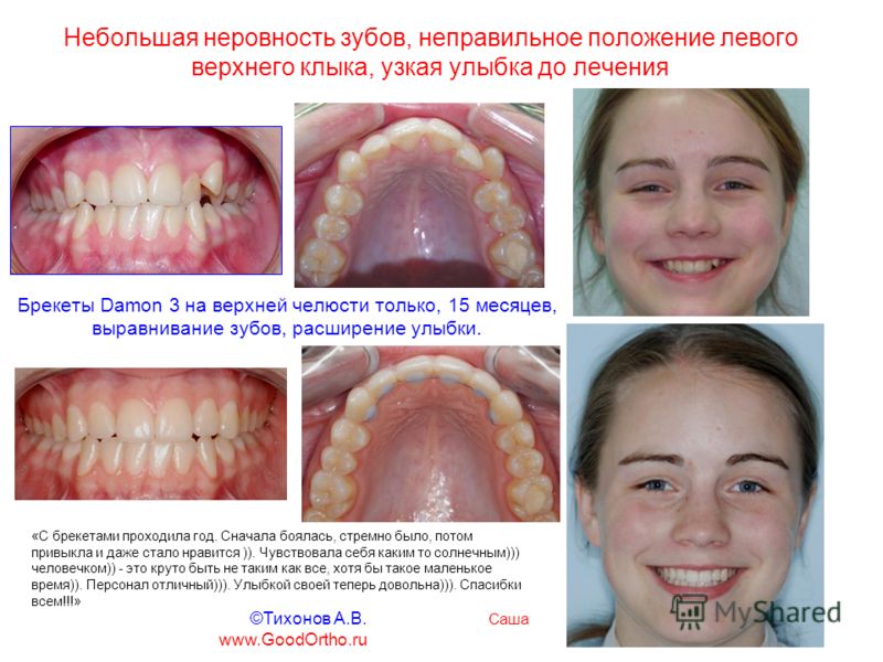Как сделать челюсти узкими Как сделать челюсти узкими