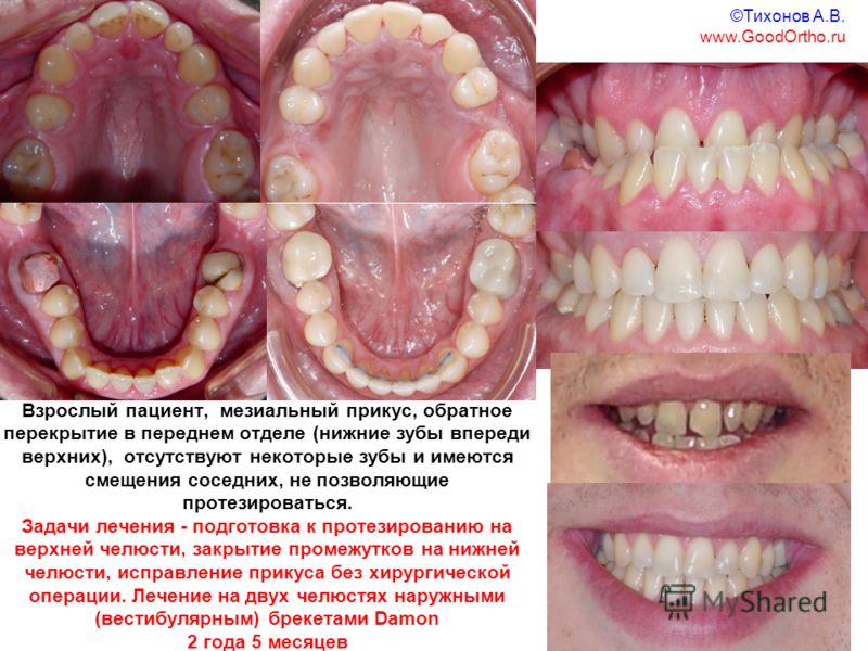 Зубы без промежутков Зубы без промежутков