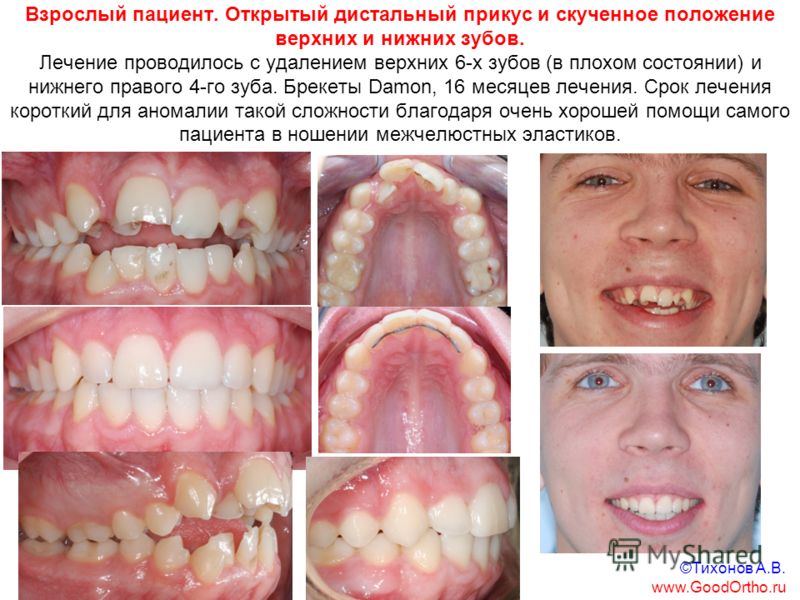 Исправление зубов сроки Исправление зубов сроки