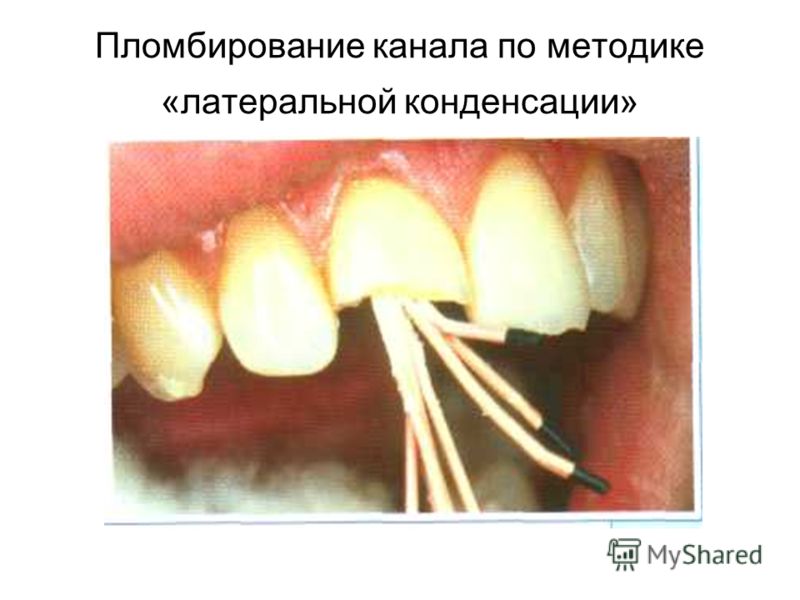 С чем закрывать канал зуба С чем закрывать канал зуба