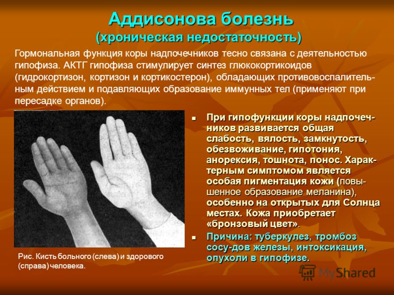 Все болезни связанные с гипофизом Все болезни связанные с гипофизом