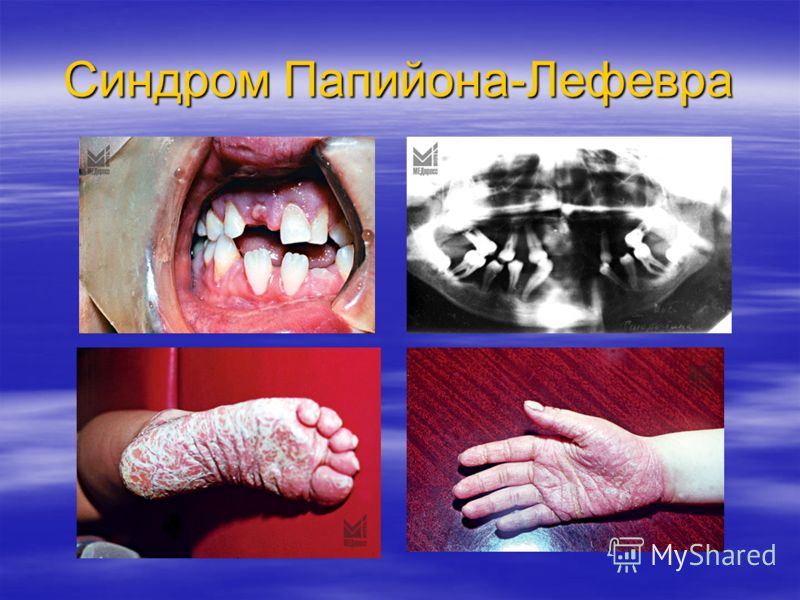 Синдром папийона лефевра реферат 9824