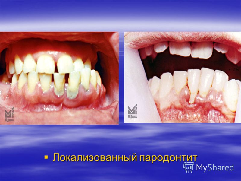 Лор заболевания при диабете i типа