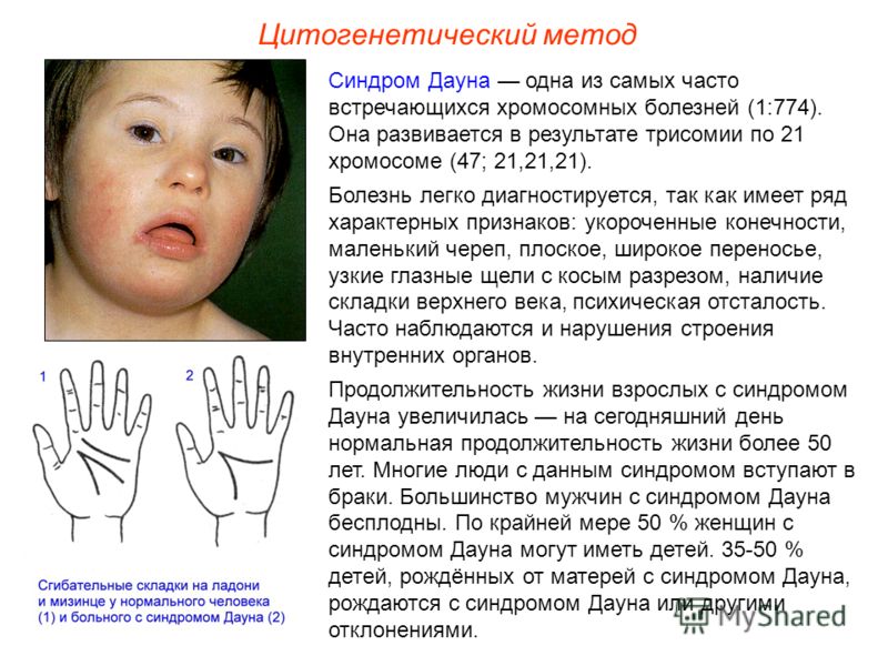 С чем связана болезнь дауна С чем связана болезнь дауна