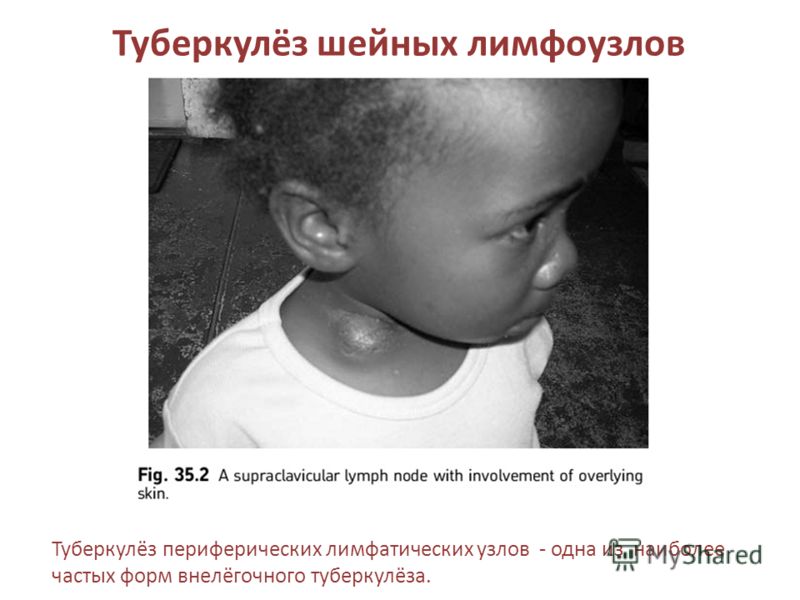Как лечат туберкулез лимфатических узлов у детей Как лечат туберкулез лимфатических узлов у детей