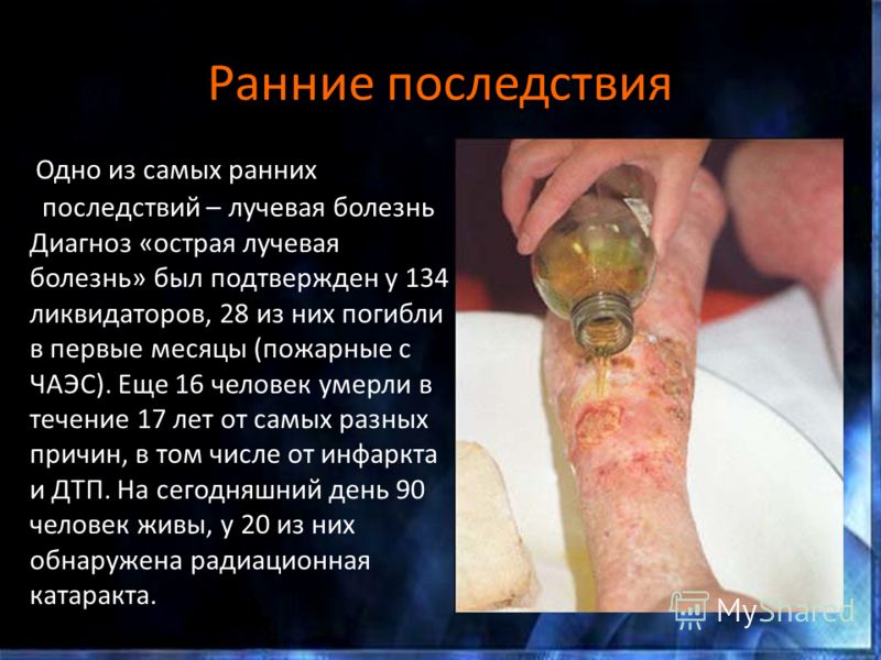 Когда была открыта лучевая болезнь Когда была открыта лучевая болезнь