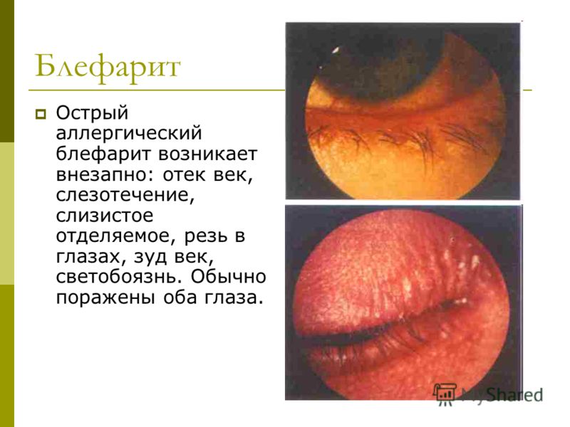 С чем связано слизистая глаза С чем связано слизистая глаза