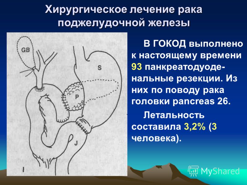Реферат по теме Онкология (рак поджелудочной железы) Реферат по теме Онкология (рак поджелудочной железы)