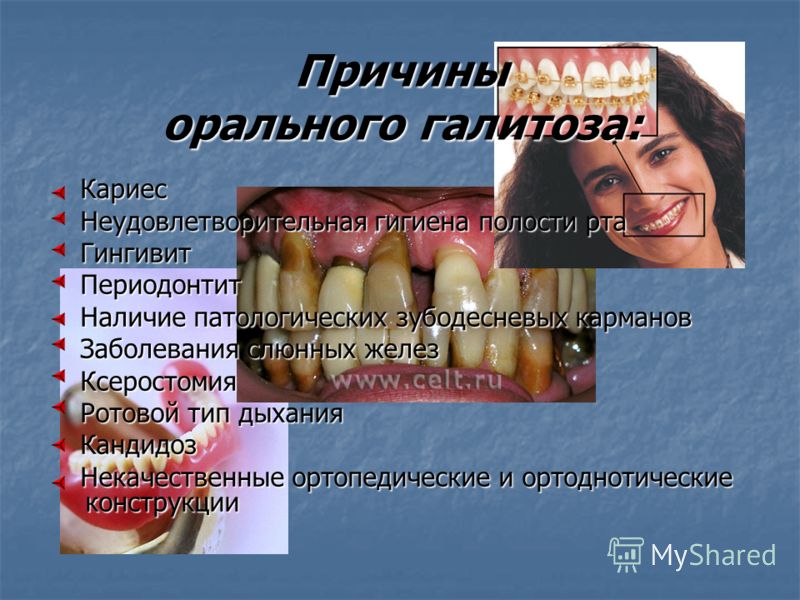 запах серы изо рта запах серы изо рта