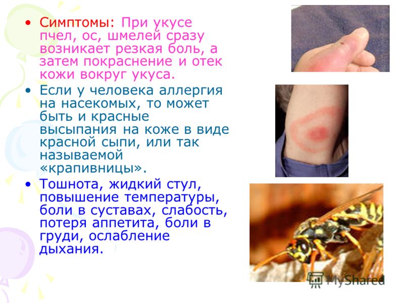 Укусы пчел лечение спины Укусы пчел лечение спины
