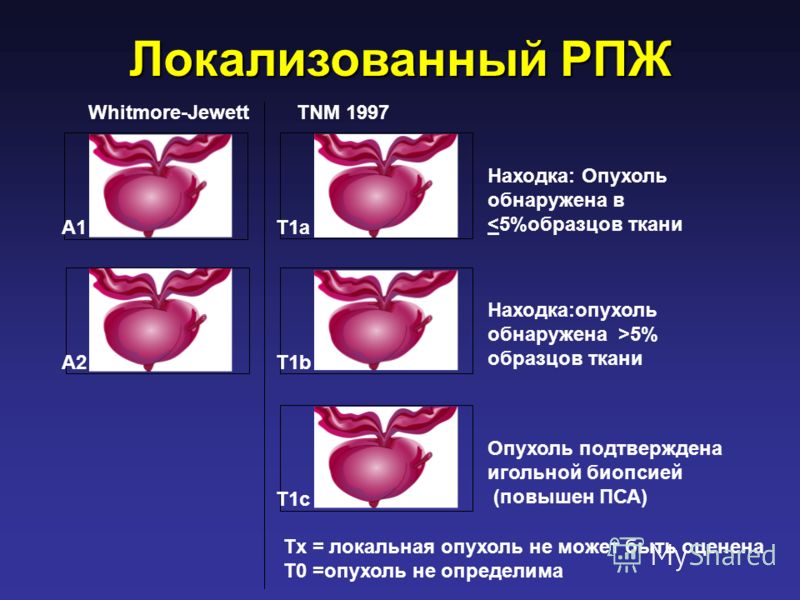 Локализованный РПЖ Whitmore-JewettTNM 1997 Находка: Опухоль обнаружена в 5% образцов ткани Опухоль подтверждена игольной биопсией (повышен ПСА) Tx = локальная опухоль не может быть оценена T0 =опухоль не определима A1 A2 T1a T1b T1c