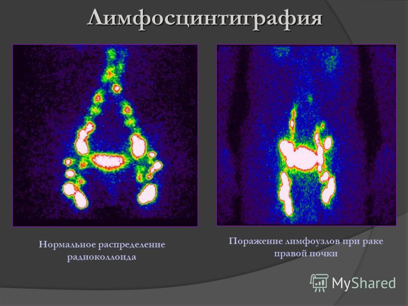 Лимфосцинтиграфия Нормальное распределение радиоколлоида Поражение лимфоузлов при раке правой почки