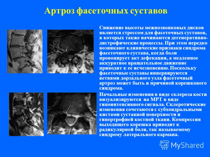 Гемангиома позвоночника лечение киев стоимость