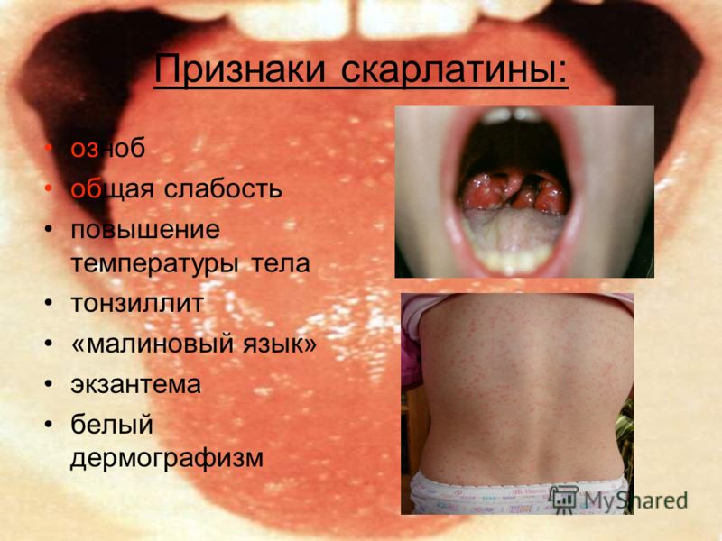 Признаки скарлатины: озноб общая слабость повышение температуры тела тонзиллит «малиновый язык» экзантема белый дермографизм