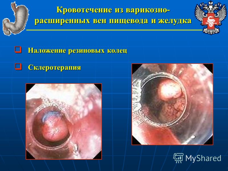Венозное расширение вен малого таза симптомы