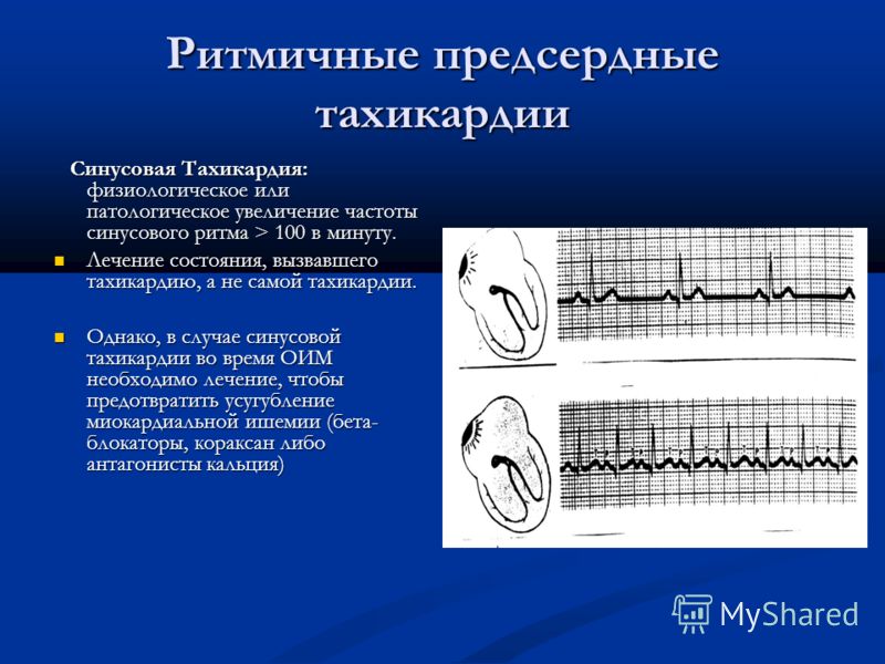 Синусовая тахикардия у беременных 13
