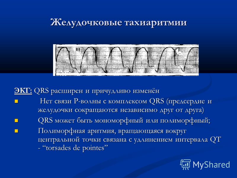 Желудочковые тахиаритмии ЭКГ: QRS расширен и причудливо изменён Нет связи Р-волны с комплексом QRS (предсердие и желудочки сокращаются независимо друг от друга) Нет связи Р-волны с комплексом QRS (предсердие и желудочки сокращаются независимо друг от