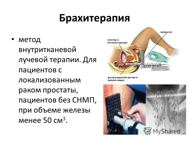Лечение хронического простатита у мужчин лекарства лучшее лечение