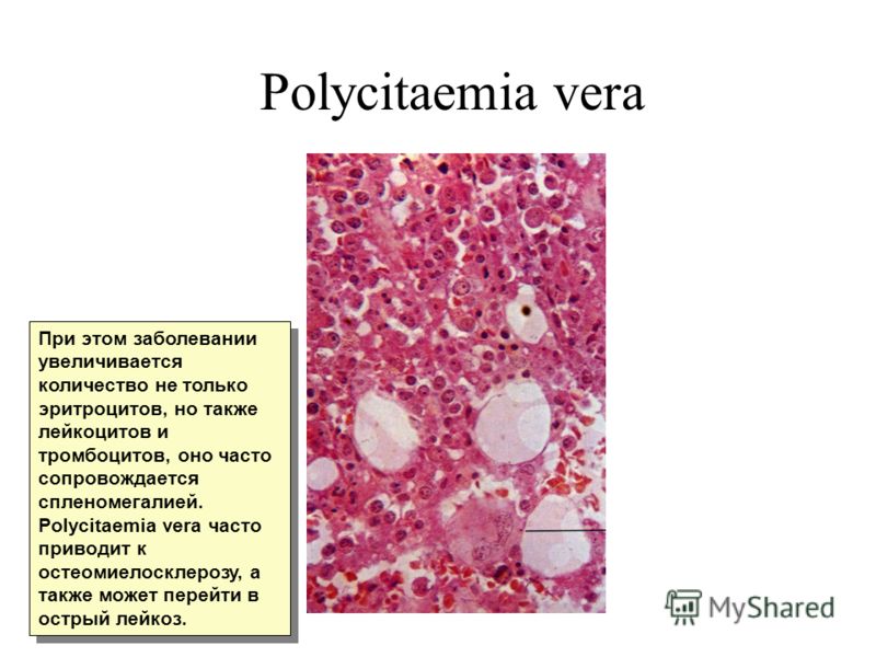 Polycitaemia vera При этом заболевании увеличивается количество не только эритроцитов, но также лейкоцитов и тромбоцитов, оно часто сопровождается спленомегалией. Polycitaemia vera часто приводит к остеомиелосклерозу, а также может перейти в острый л