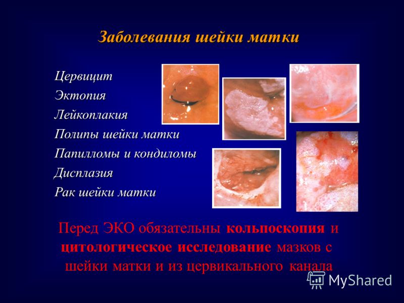Polyprpilene, форум по цитологии дисплазия 2 людей нашей