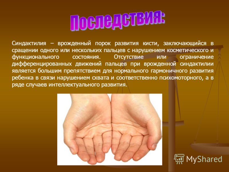 Синдактилия – врожденный порок развития кисти, заключающийся в сращении одного или нескольких пальцев с нарушением косметического и функционального состояния. Отсутствие или ограничение дифференцированных движений пальцев при врожденной синдактилии я