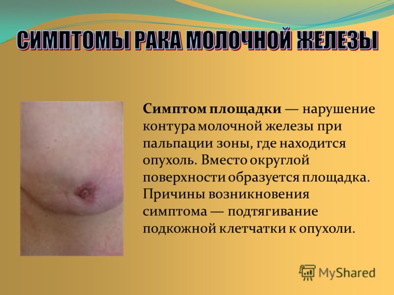 Что делать если рак молочной железы