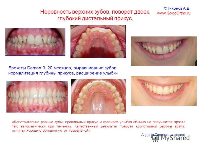 Как скрыть что нет зубов Как скрыть что нет зубов