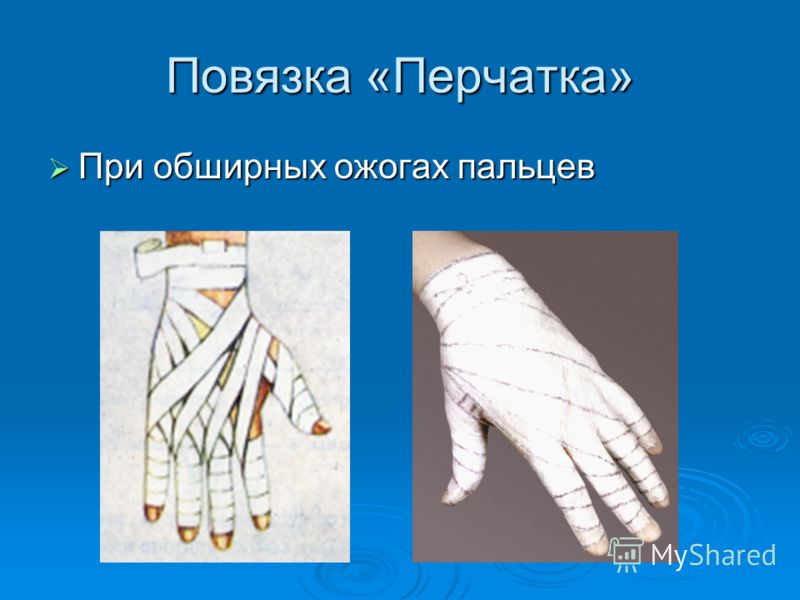 Как сделать перевязку при ожогах 75 Как сделать перевязку при ожогах 160