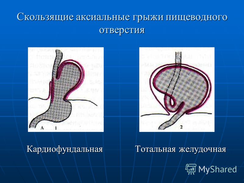 Диета При Аксиальной Грыже