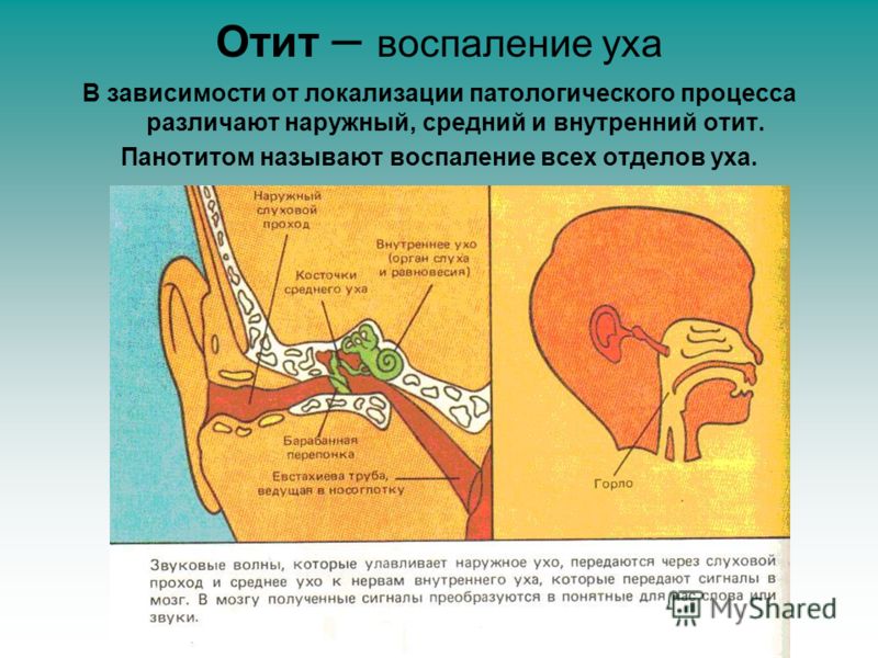 Отит – воспаление уха В зависимости от локализации патологического процесса различают наружный, средний и внутренний отит. Панотитом называют воспаление всех отделов уха.