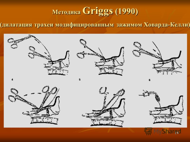 14 Методика Griggs (1990) (дилатация трахеи модифицированным зажимом Ховарда-Келли)