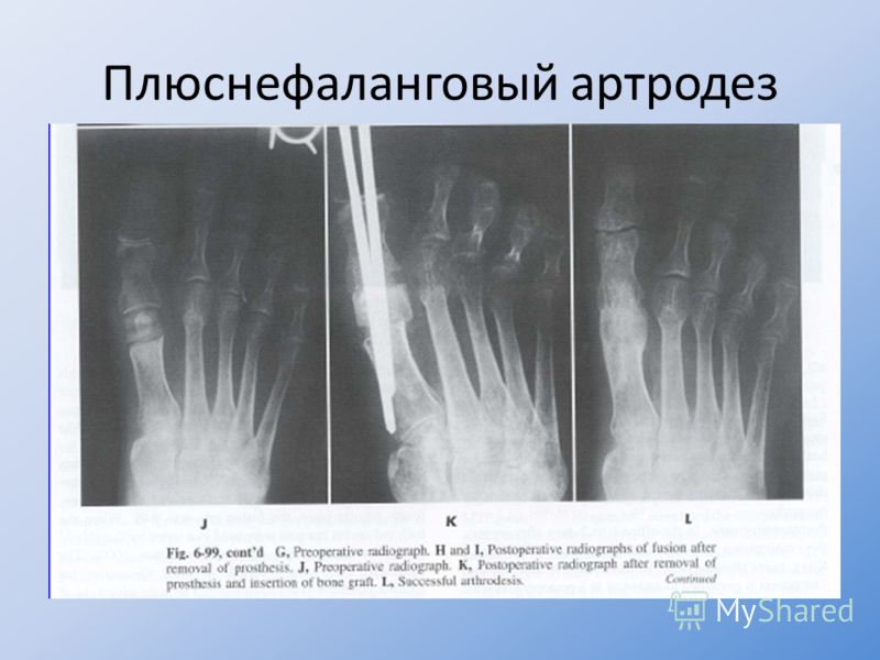 как вылечить плюснефаланговый сустав как вылечить плюснефаланговый сустав